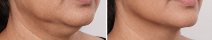 Before and after facial lifting